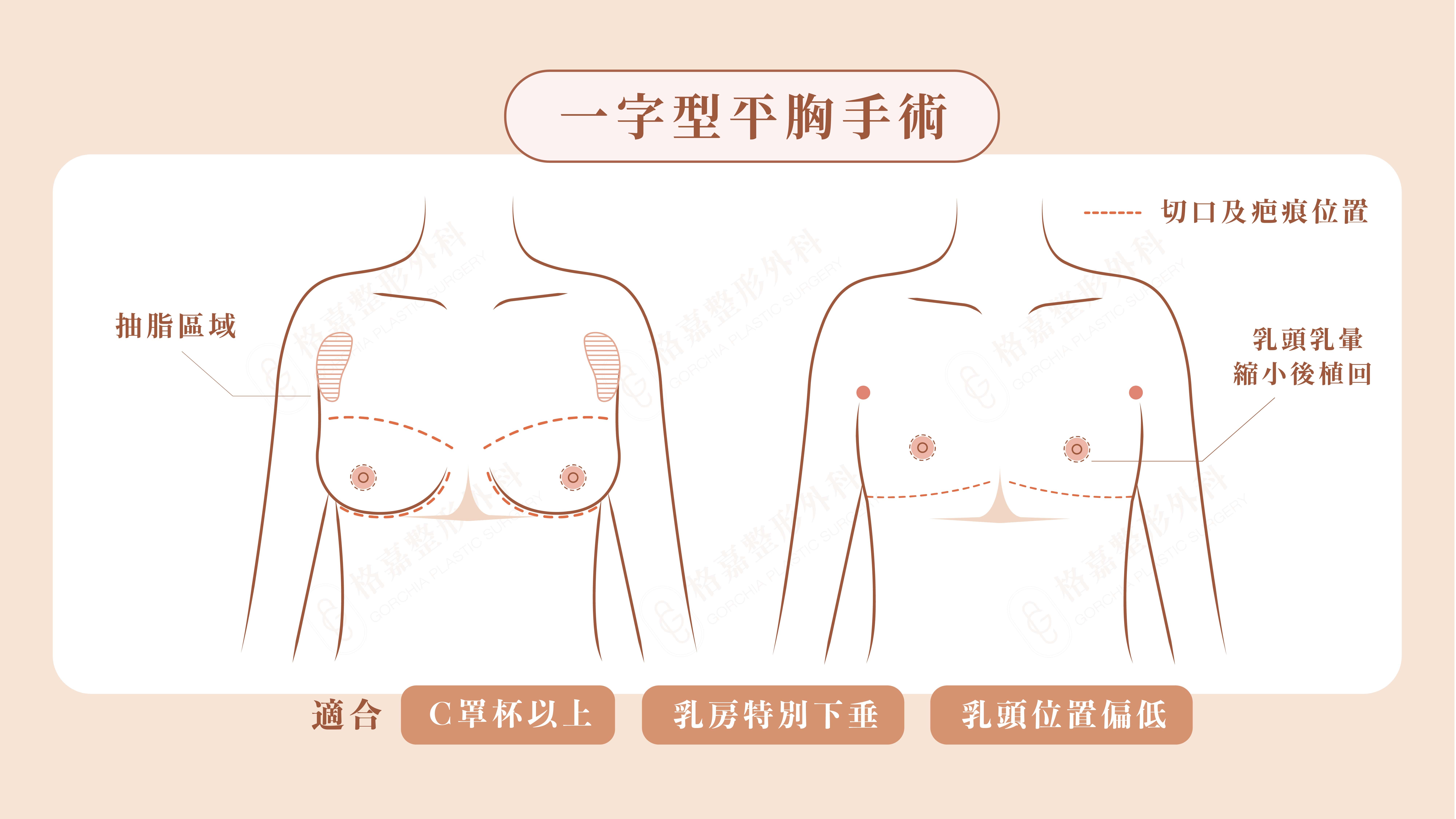 一字平胸
